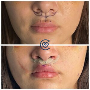 LIPPENSTRAFFUNG (LIPPEN-LIFTING)