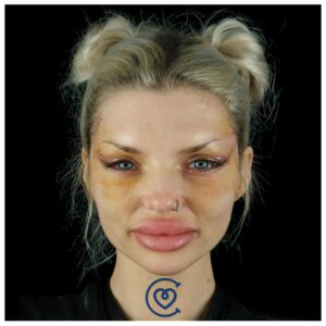 Kanthoplastik