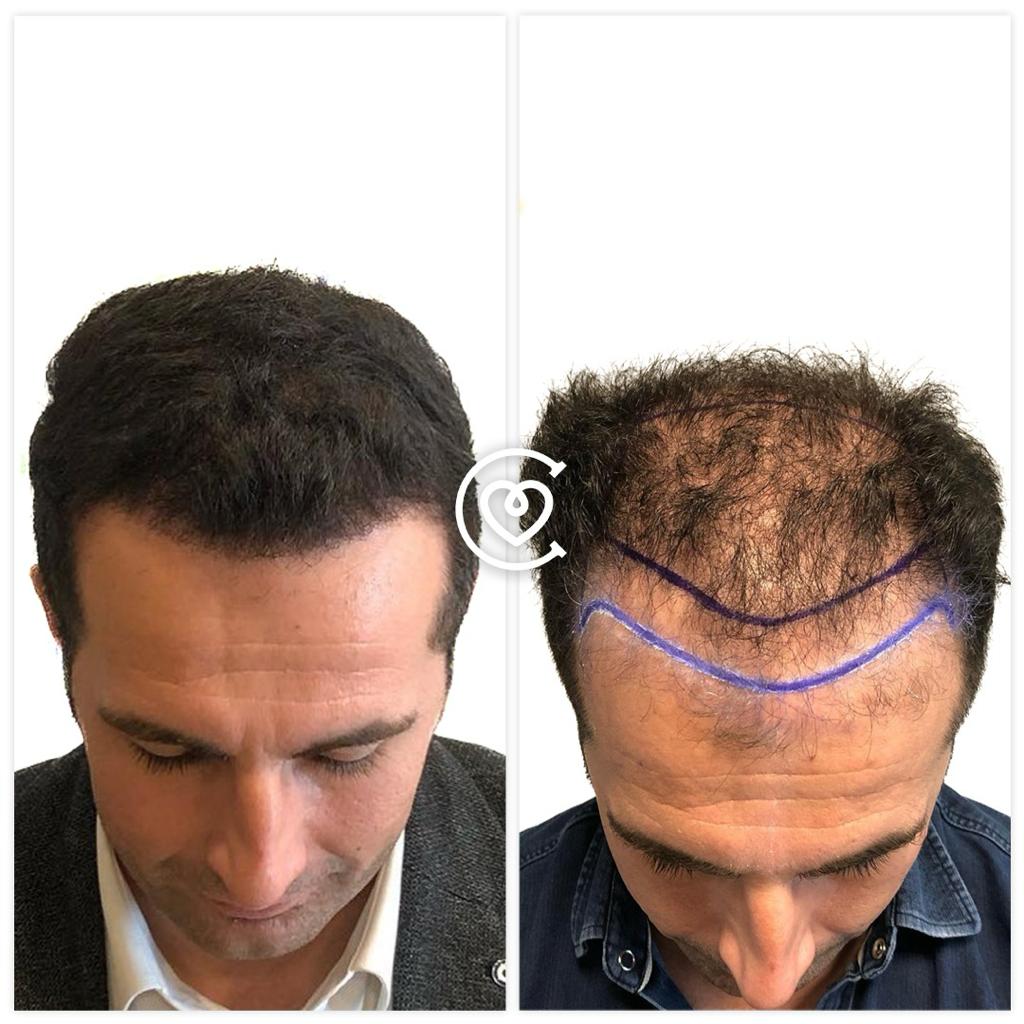 Haartransplantation in der Türkei