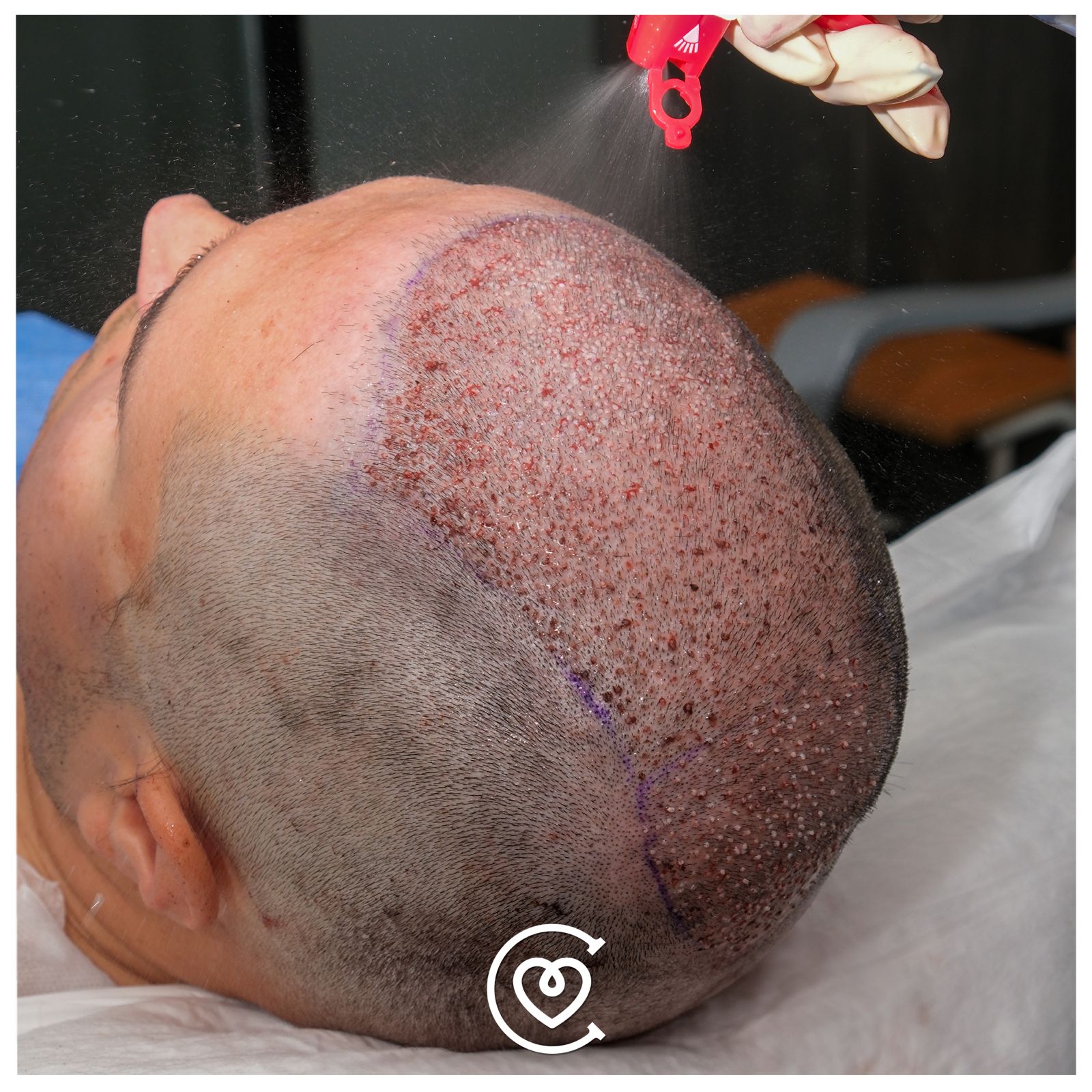 Saphir-Fue-Haartransplantation