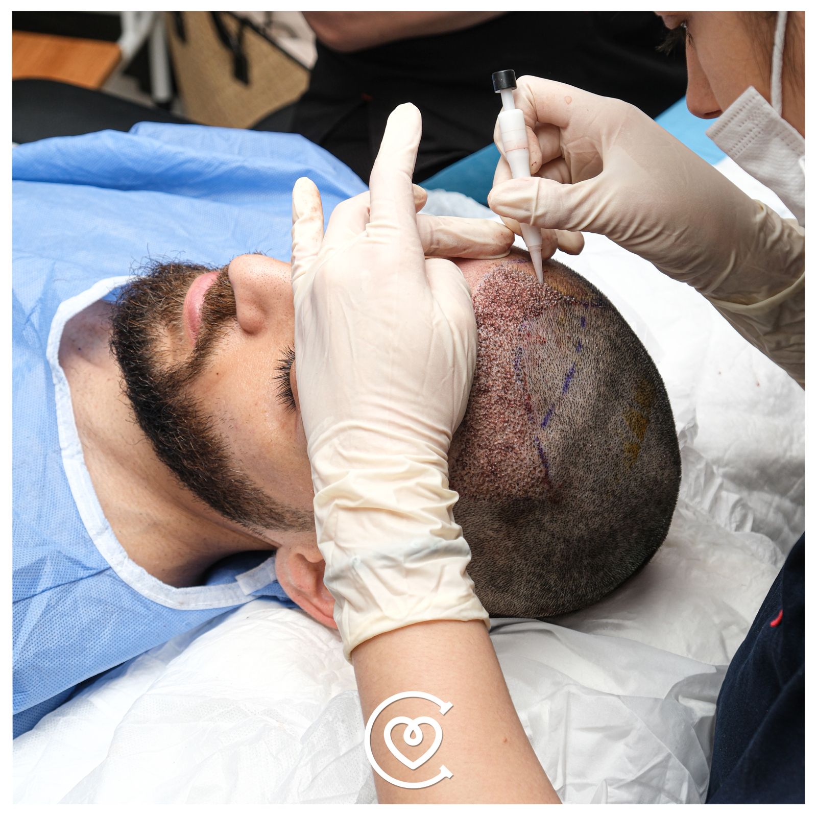 DHI-Haartransplantation in der Cayra Klinik.