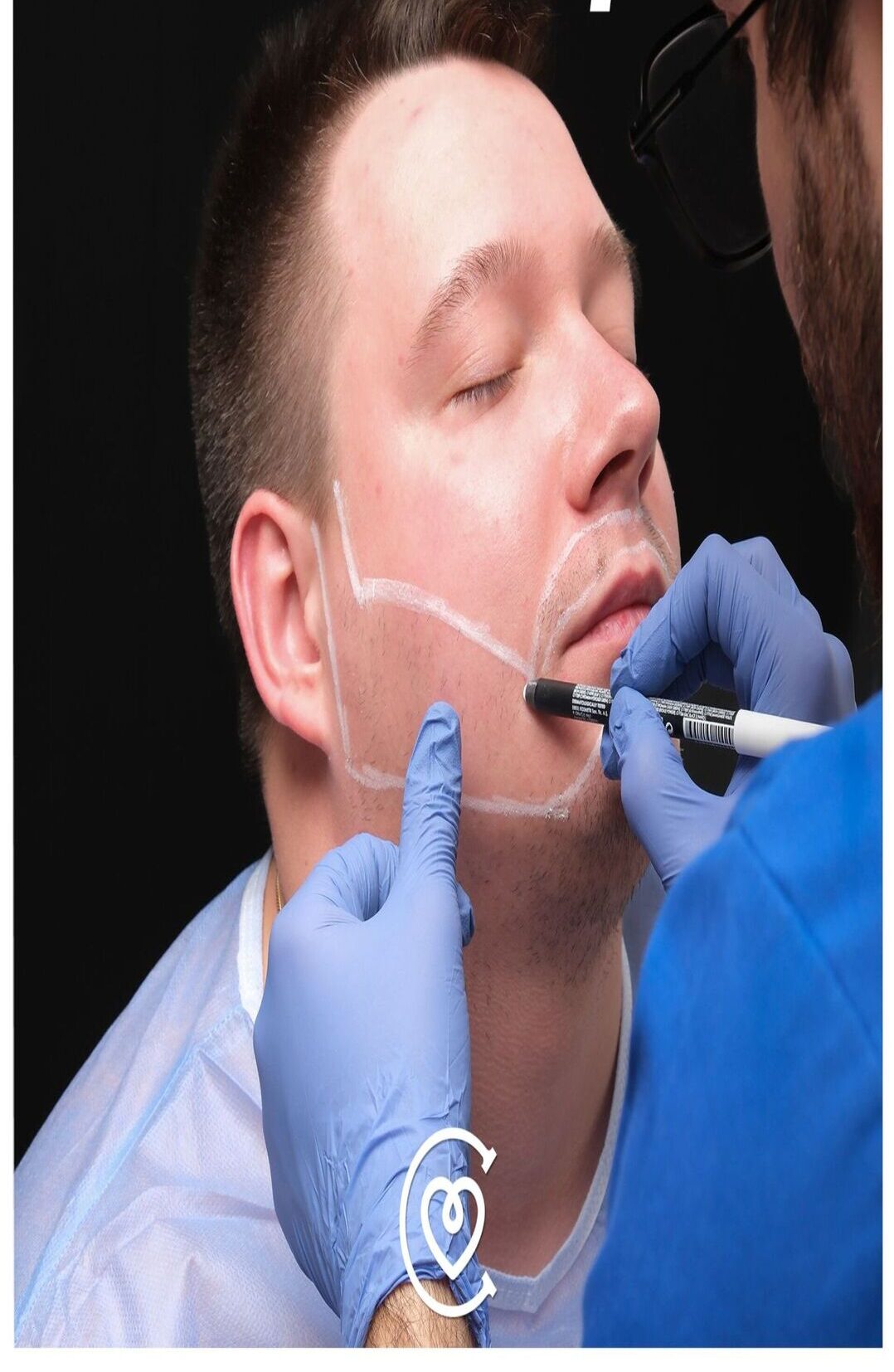 Barttransplantation in der Türkei