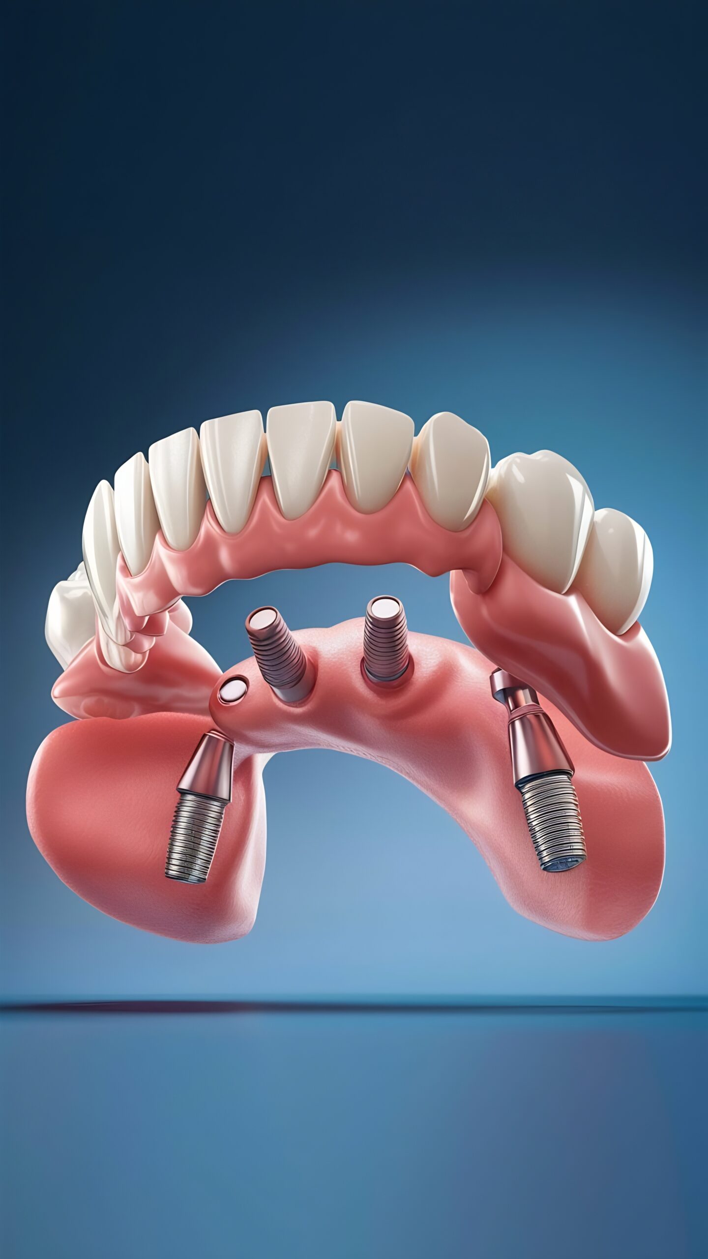 Zygoma-Implantate:
