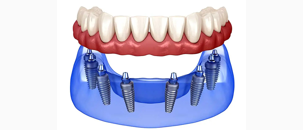 All-on-Six-Implantat