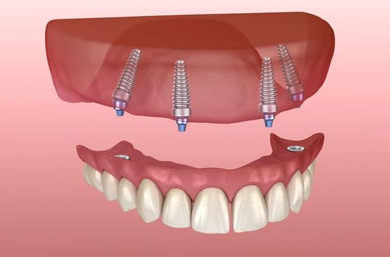 All-on-4 Implants Türkiye Guide