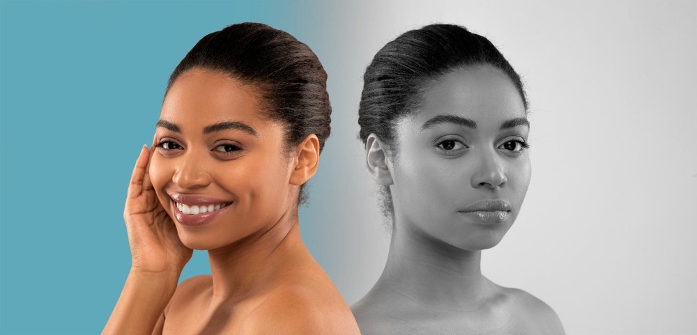 Vorher-nachher-Vergleich eines Facelifts.