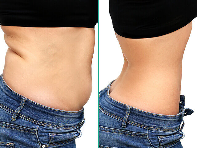 Abdominoplastik-Vorher-Nachher