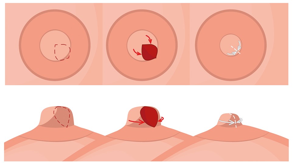 Ablauf einer Brustwarzenverkleinerung a