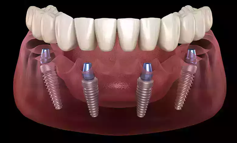 All-on-4-Zahnimplantate