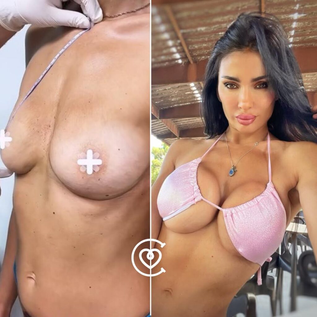 Brustvergroesserung-Vorher-Nachher