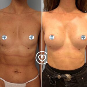 Brustvergrößerung Vorher-Nachher