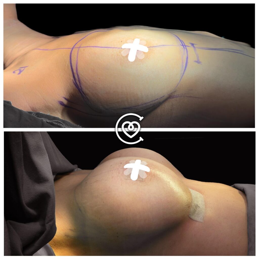Brustvergroesserung-Vorher-Nachher turkei