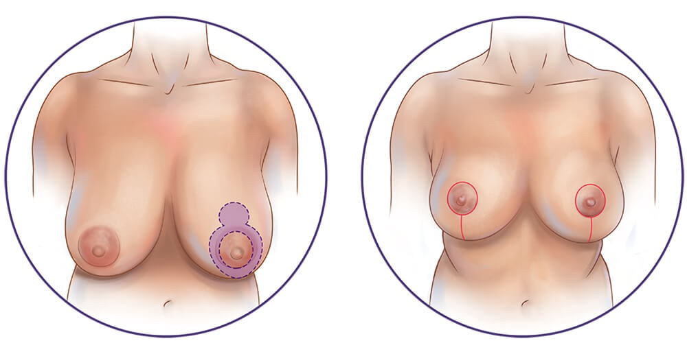 Brustverkleinerung und Bruststraffung in der Türkei