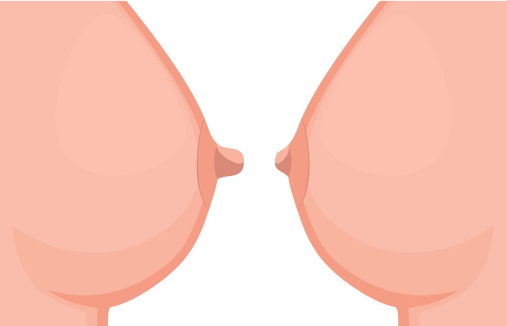 Brustwarzenverkleinerung Chirurgie