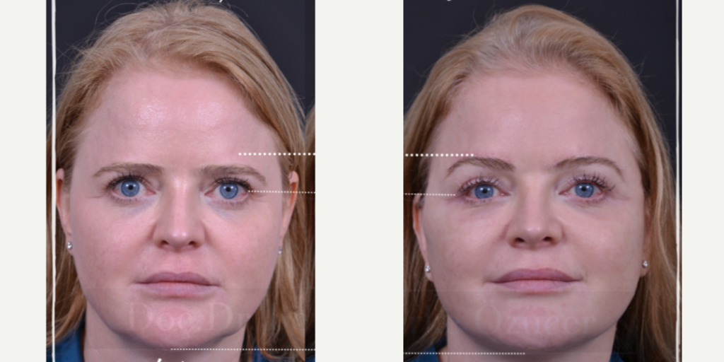 Deep Plane Facelift in der Türkei