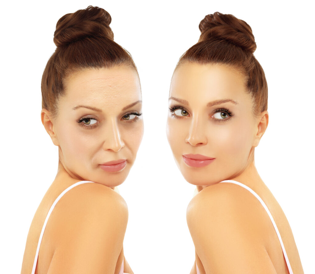 Gesichtsverjüngungschirurgie in der turkei