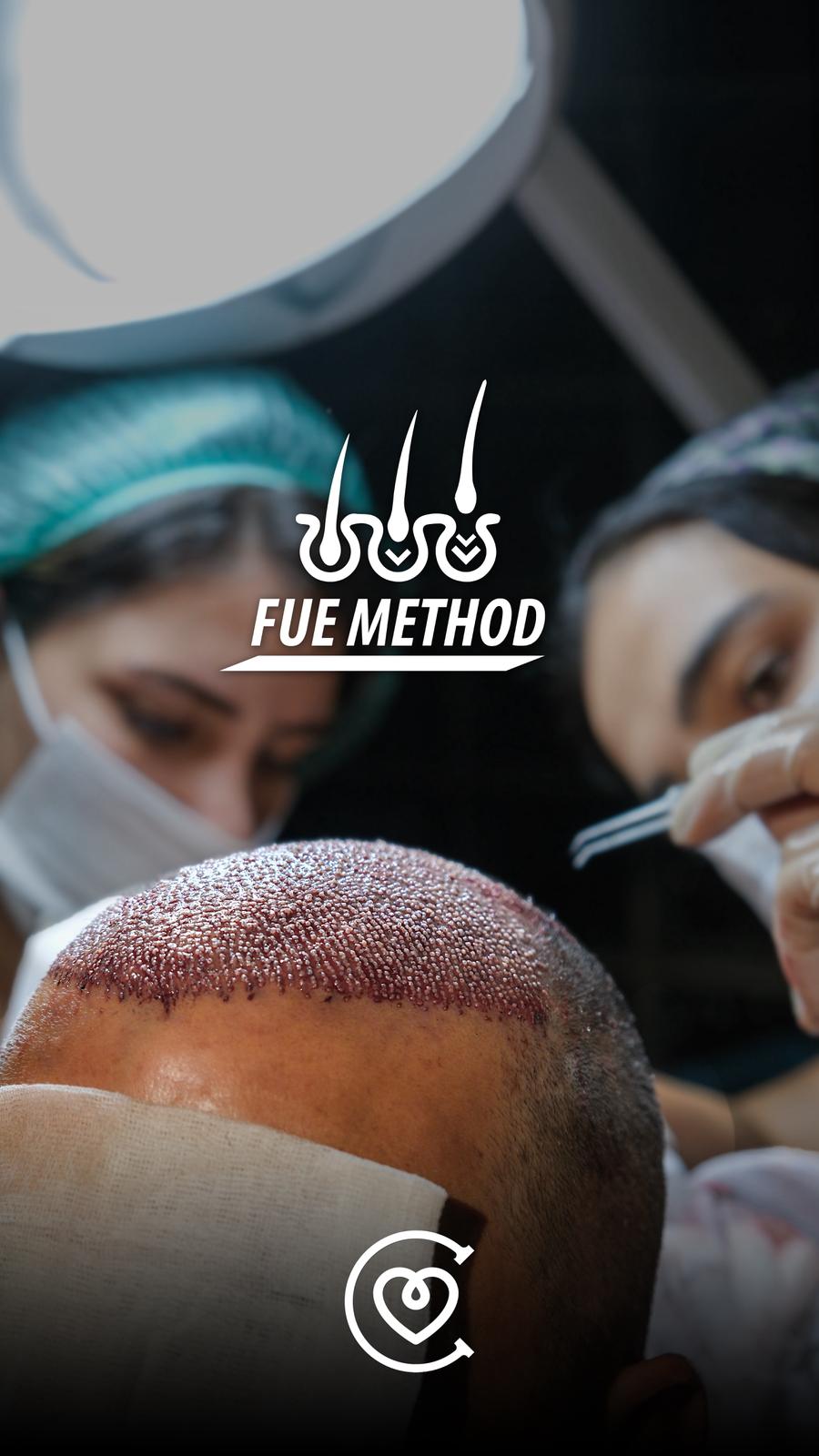 FUE-Methode