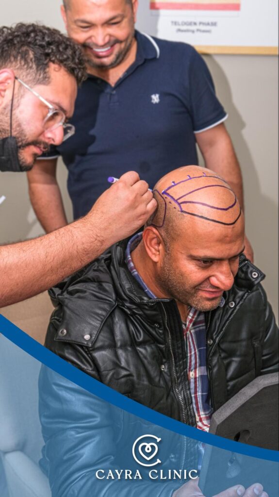 FUE oder DHI Haartransplantation in Istanbul