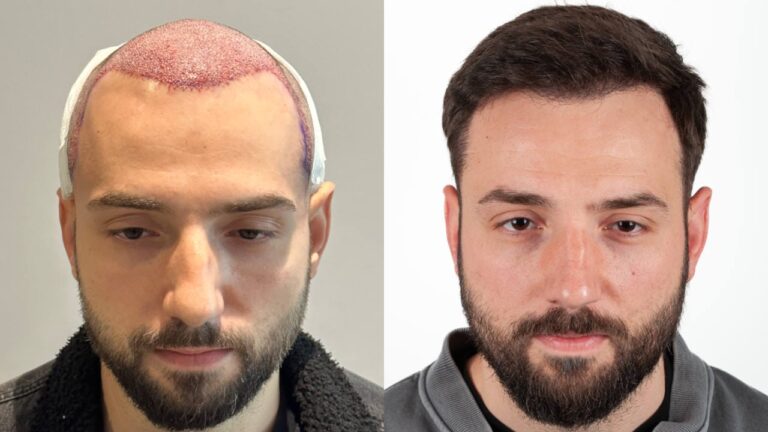 FUE-oder-DHI-Haartransplantations