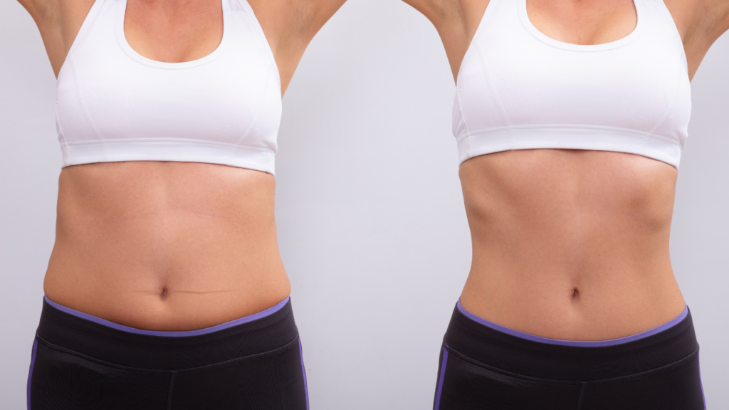 Fettabsaugung-in-der-Tuerkei