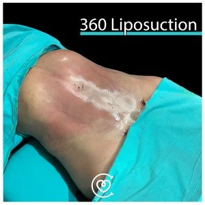 Fettabsaugung in der Türkei