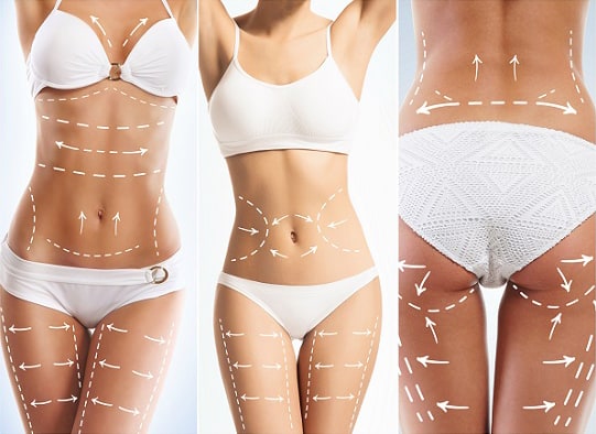 Liposuktionsbereiche​