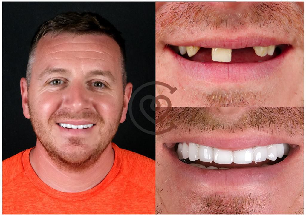 hollywood laecheln in turkei