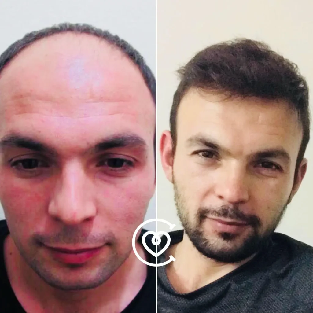 Rauchen und Haartransplantation Turkei