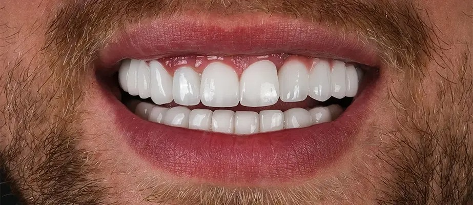 veneers