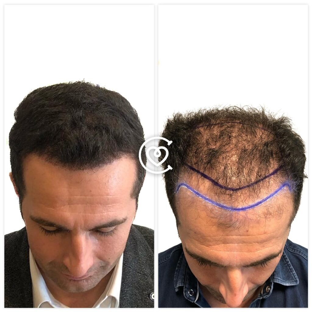 5000 Grafts Haartransplantation Kosten