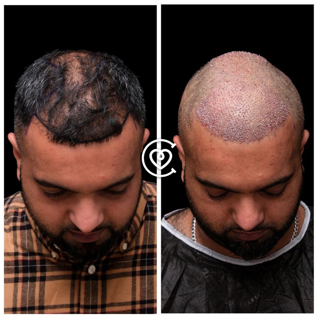 5000 Grafts Haartransplantation