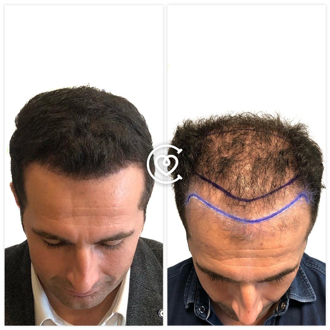 5000 Grafts Haartransplantation Kosten