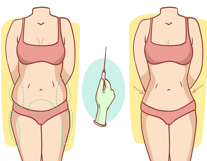 Bauchstraffung vs. Mini-Bauchstraffung Was passt zu Ihrer Körperform