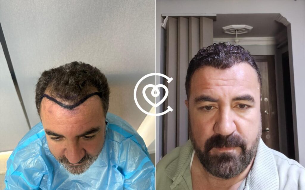 DHI-Haartransplantation ohne Rasur