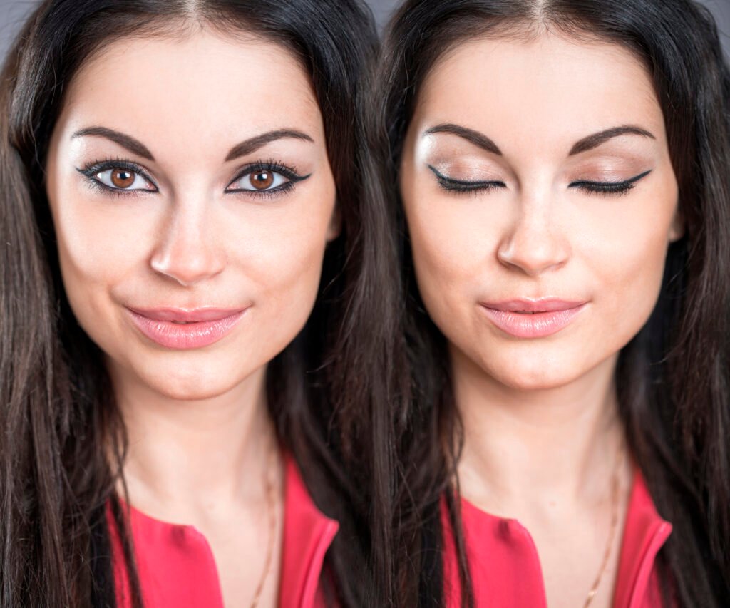 Deep Plane Facelift Turkei