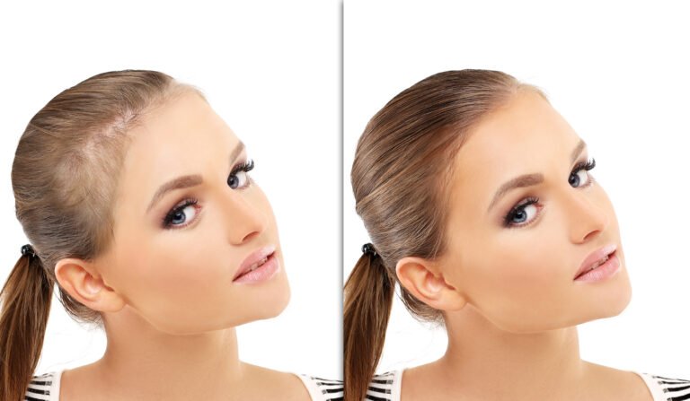 Frauen-Haartransplantation in der Turkei