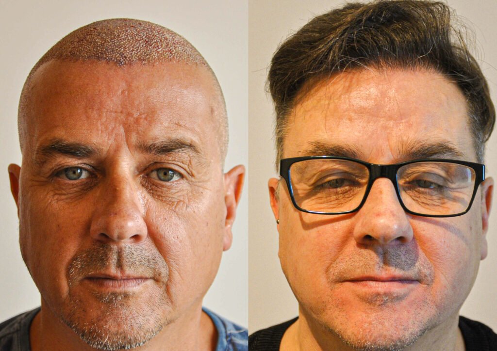 Haartransplantation Finanzierung Turkei