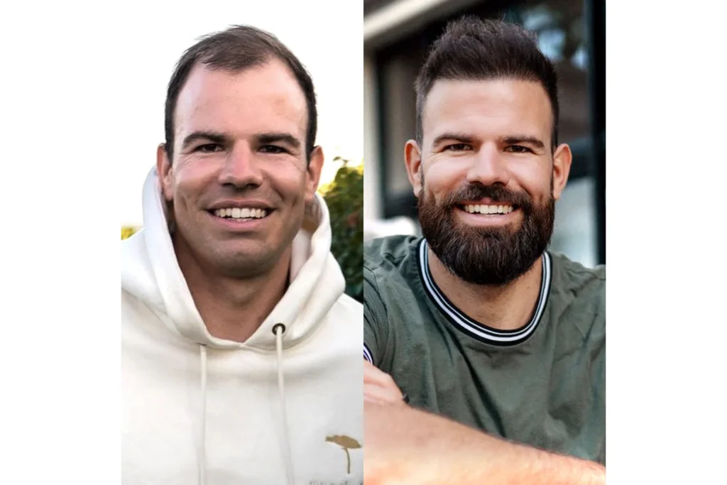 Haartransplantation Finanzierung für Deutsche