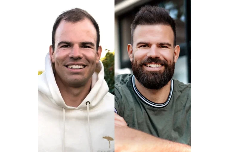 Haartransplantation Finanzierung für Deutsche