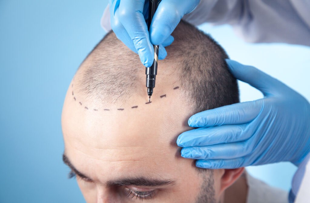 Haartransplantation Korrekturen