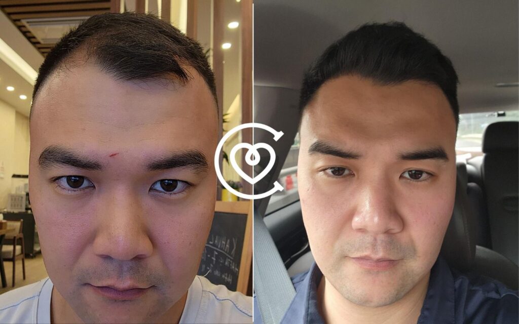 Haartransplantation Türkei vs Deutschland