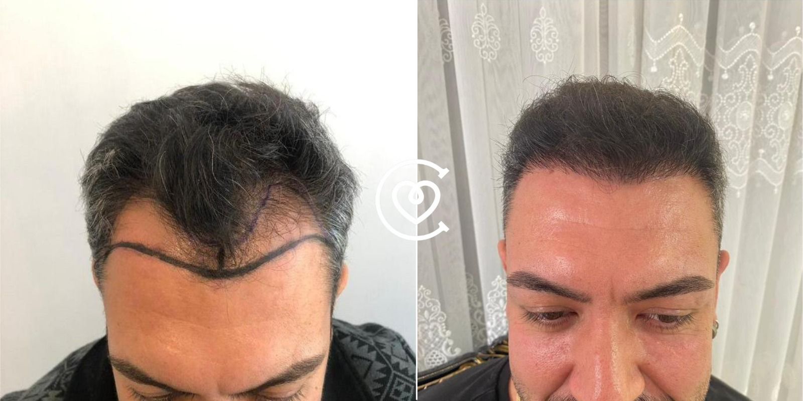 Haartransplantation Türkei
