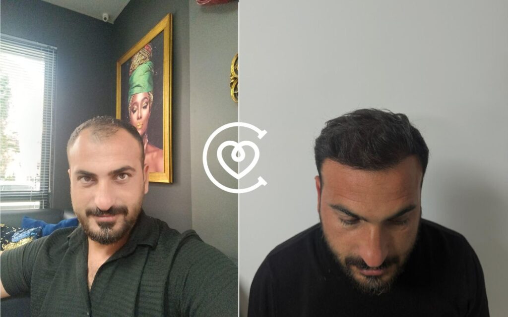 Haartransplantation in der turkei