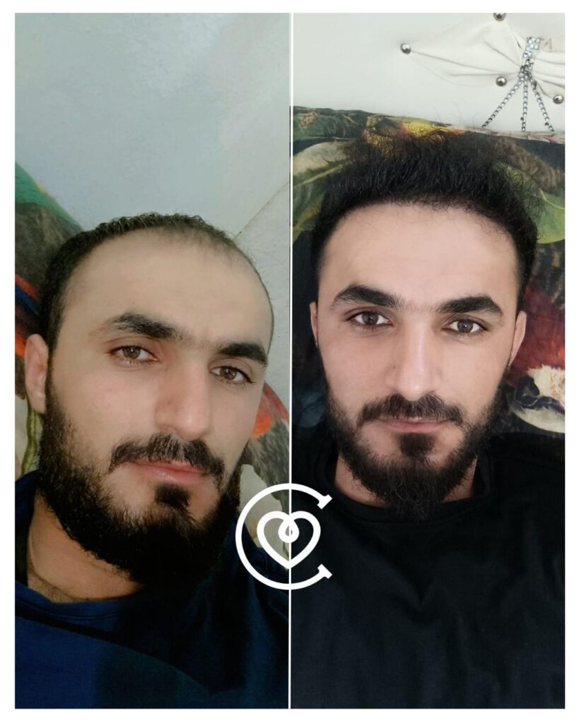 Haartransplantation ohne Rasur