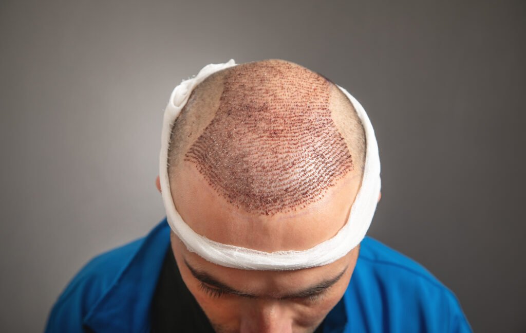 Saphir FUE Haartransplantation