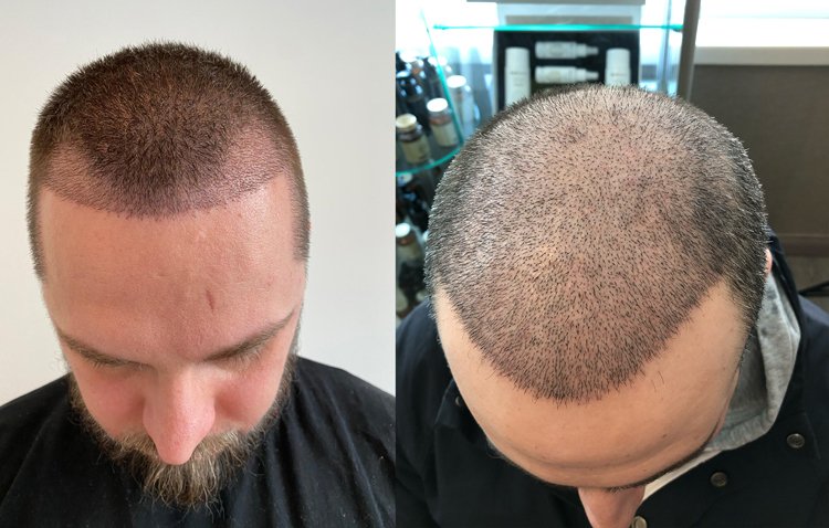 Shock Loss Haartransplantation Turkei