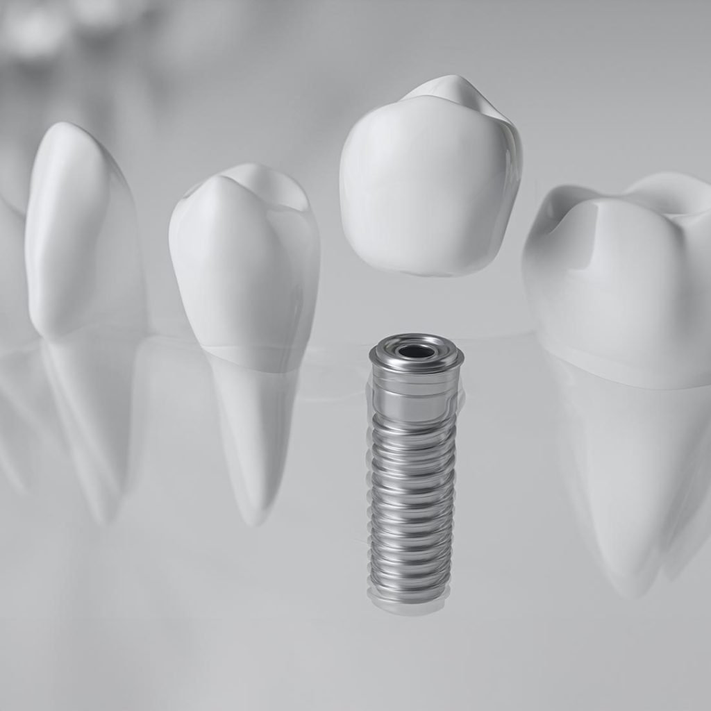 Zahnimplantat-Materialien 2026 – Titan vs. Keramik