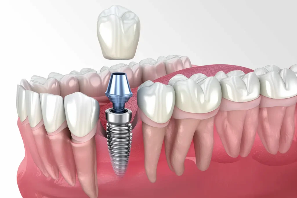 Zahnimplantat-Verlust