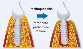 Zahnimplantat Verlust