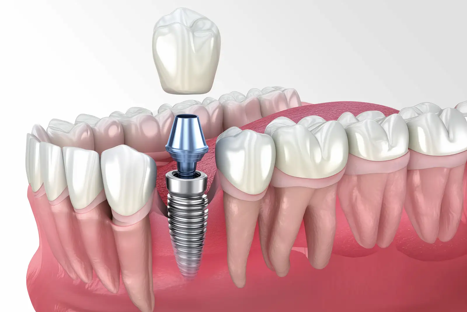 Zahnimplantat-Verlust
